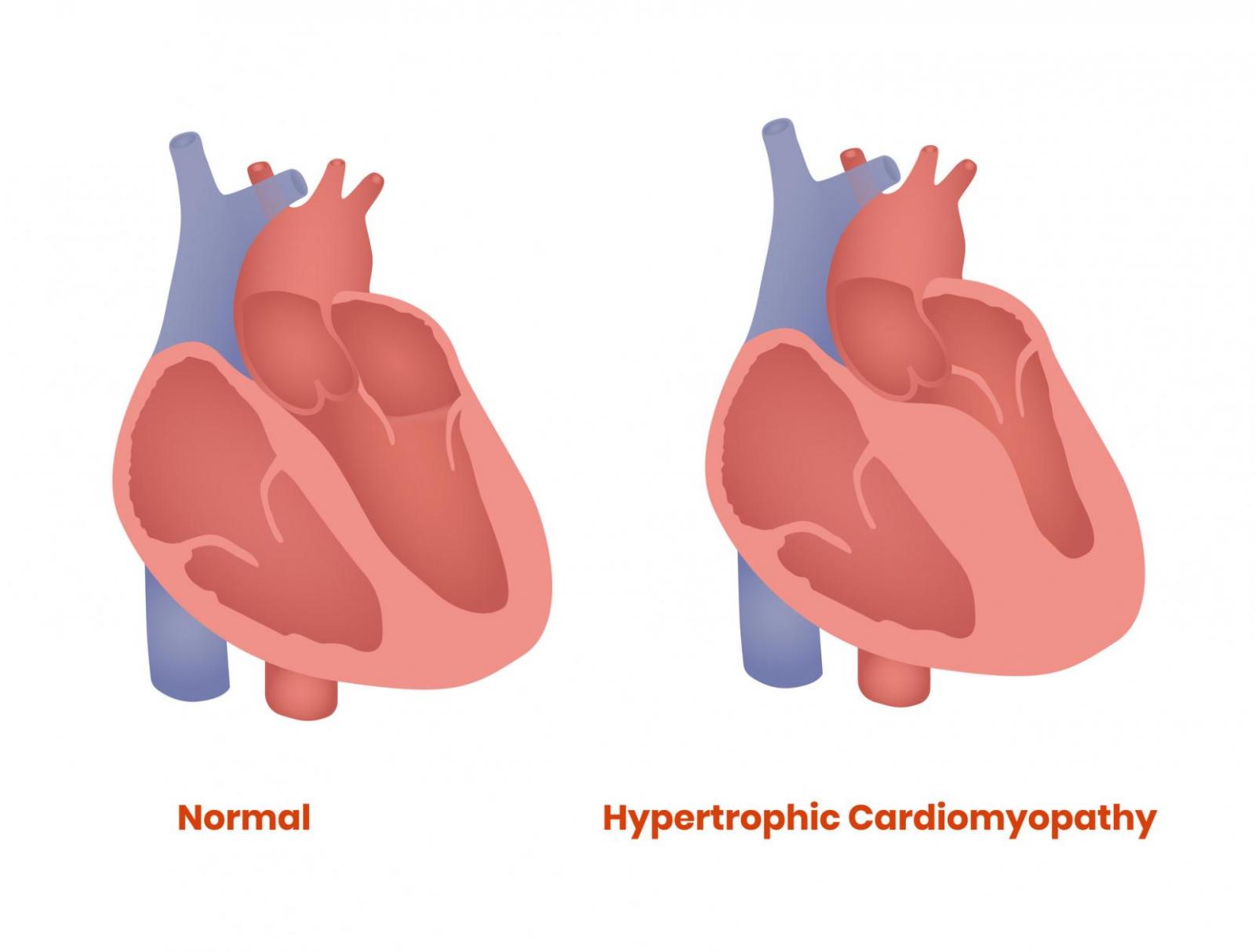 Hypertrophic Cardiomyopathy Treatment - NYC | Division Of Cardiology